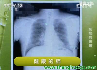 肺炎X光片图1
