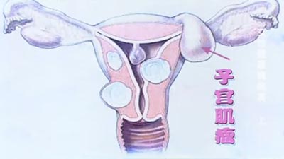 子宫肌瘤与月经