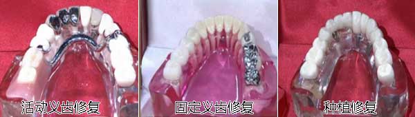 牙齿三种修复方法效果图