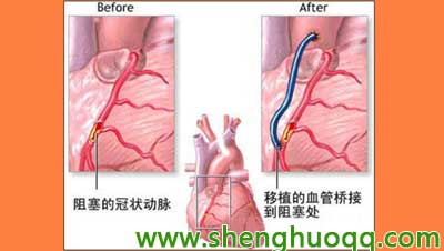 心脏搭桥手术图解图片