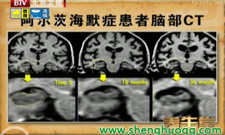 阿尔兹海默症患者大脑萎缩过程