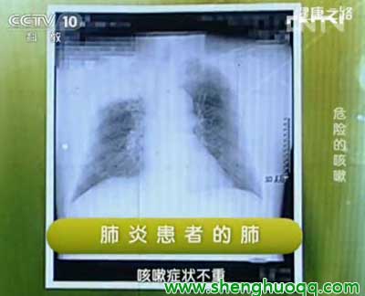 肺炎X光片图2