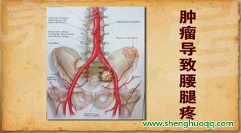 肿瘤导致腰腿疼