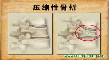 压缩性骨折