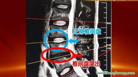 腰椎间盘突出