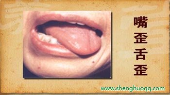 脑卒中症状