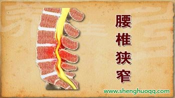腰椎狭窄
