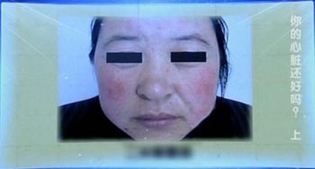 心脏病的外表特征