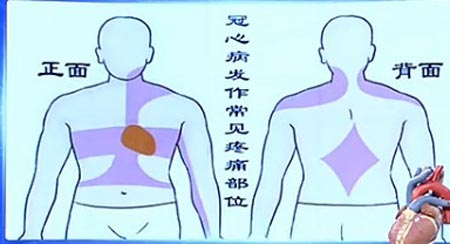 心脏引起的疼痛放射图