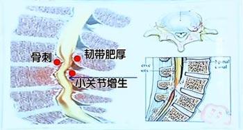 椎管狭窄