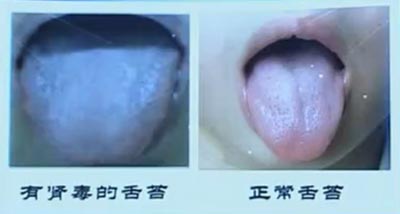 有肾毒的舌苔的表现