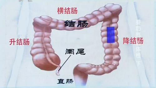 结肠癌会遗传