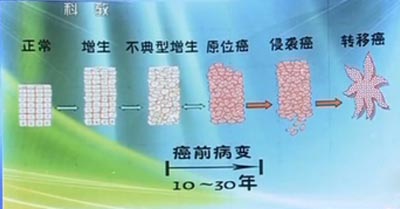 癌症的发展过程 癌症的发展过程