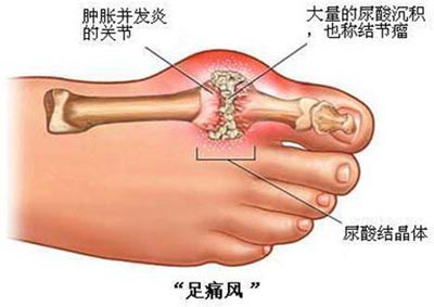 痛风足