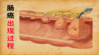 肠癌