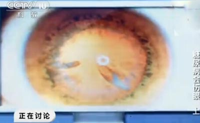 混浊向中央走