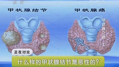 甲状腺恶性与良性之分