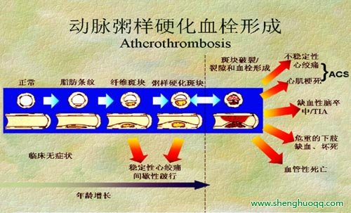 动脉粥样硬化