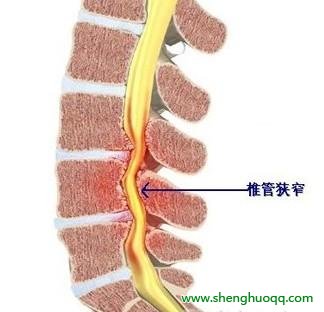 椎管狭窄