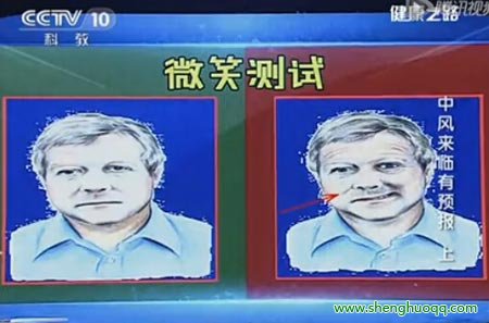 中风的微笑测试