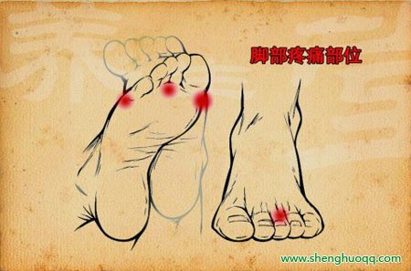 没有足弓的鞋会导致足部的内侧疼痛