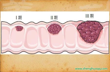 大肠癌