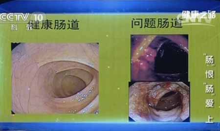 肠道健康