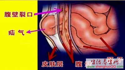 养生堂20141217疝气是什么病