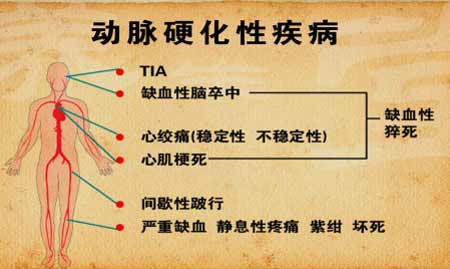 动脉硬化性疾病