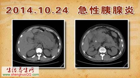 急性胰腺炎