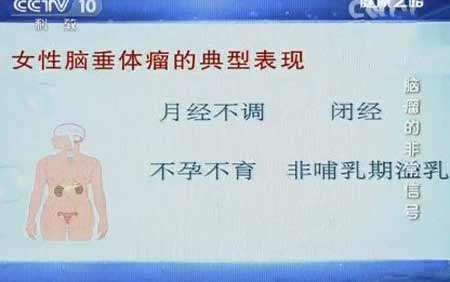 女性脑垂体瘤的表现