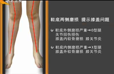 鞋底两侧磨损提示膝盖问题