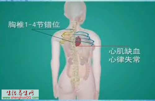 胸椎错位-图2