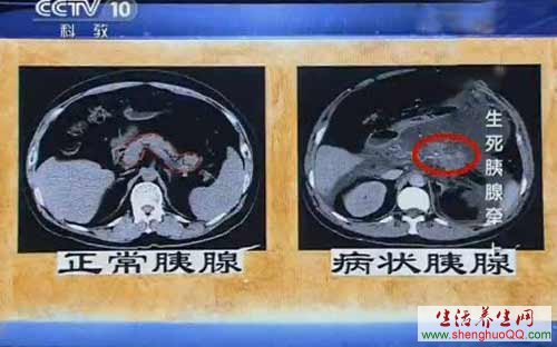 急性胰腺炎