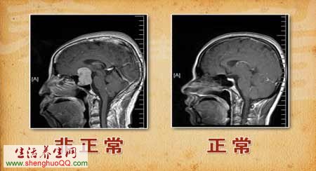 肢端肥大症-图2