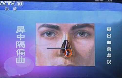 鼻中隔偏曲