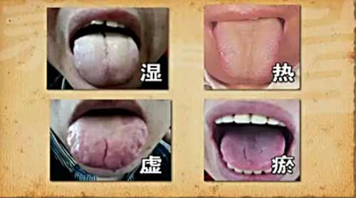 四种症候的舌相