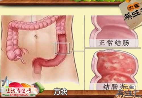 正常结肠与结肠炎对比