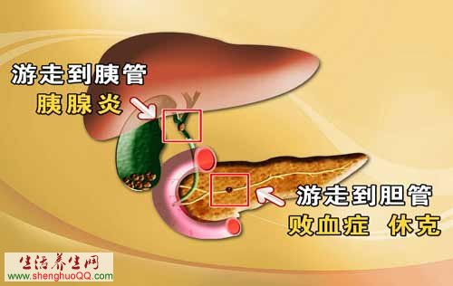 胆结石引起胰腺炎