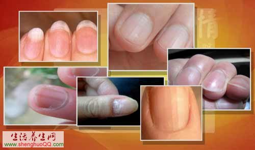 指甲预示着的健康隐患据