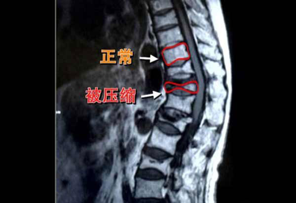 隐形骨折危害大