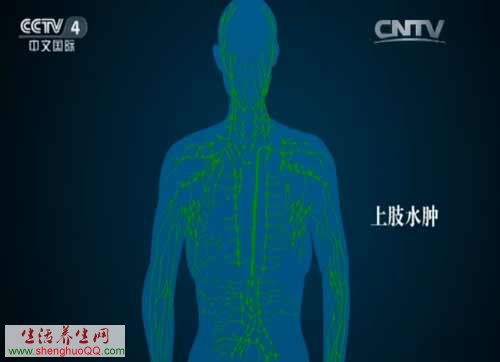 乳腺癌治疗后水肿