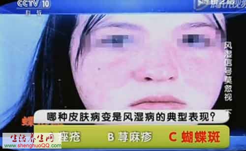 风湿性疾病可引发红斑儿狼疮