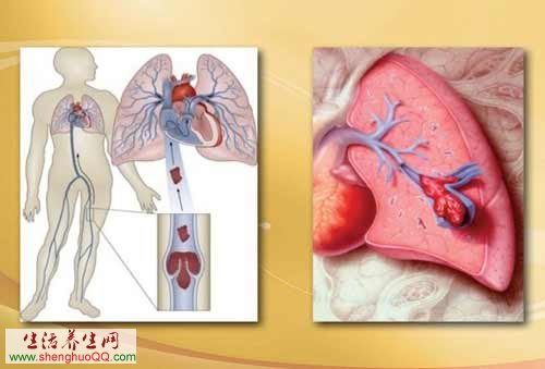 肺栓塞高危人群