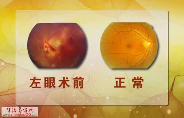 斯琴高娃的眼底病变