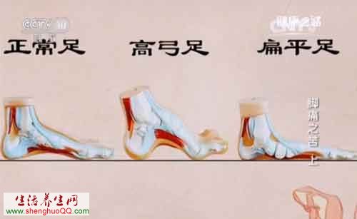 脚型