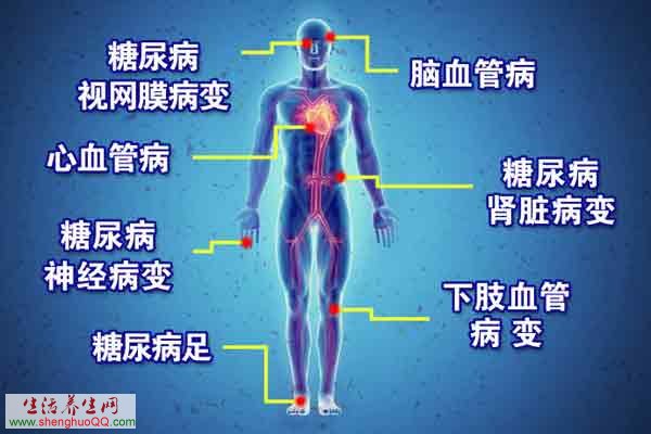 糖尿病并发症