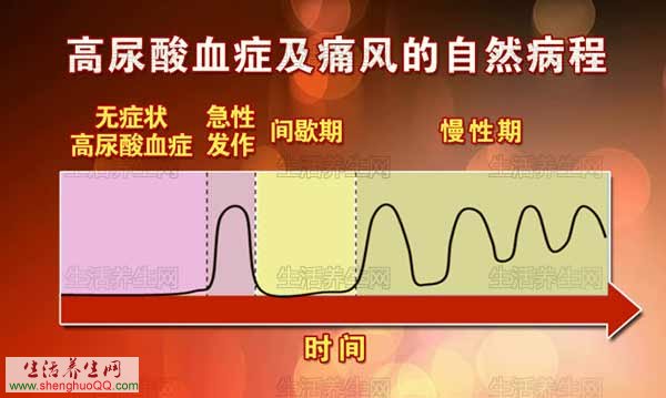 高尿酸血症及痛风的自然病程