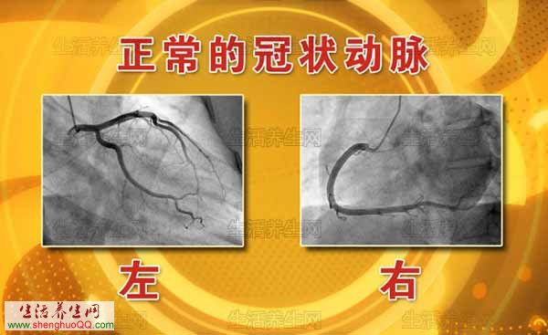 年轻人患得冠心病