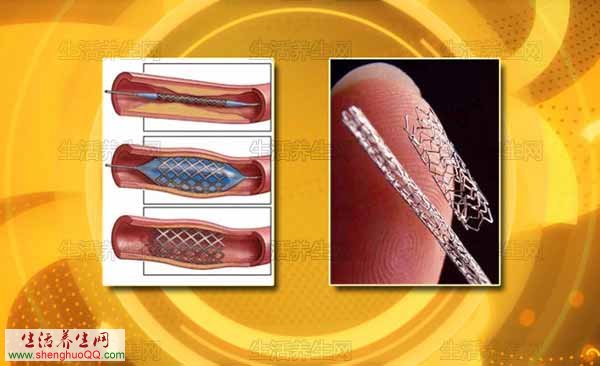 心脏支架原因图、效果图